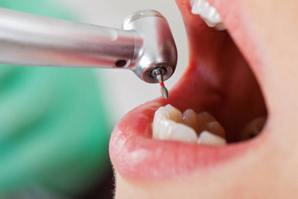 Best Broken or Chipped Tooth Repair in Vassar College, NY
